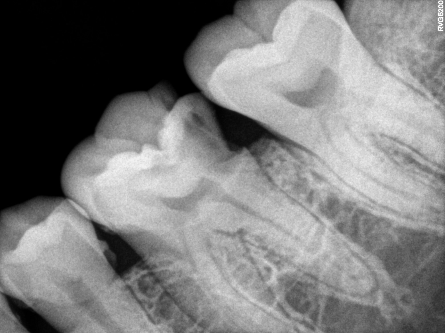 Dental X-ray